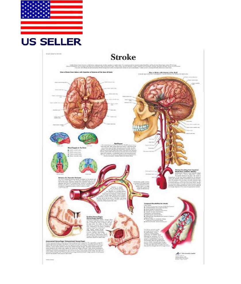 Stroke Poster/ Stroke Chart/ Anatomical Reference/ 16”x 24” W Silk Fabric