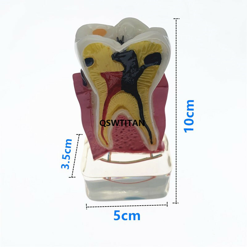 Teeth Model 4 times tooth pathology model Periodontal Teaching Study model
