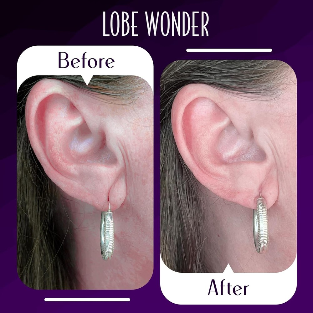 Lobe Wonder - The Original Ear Lobe Support Patch For Pierced Ears - E