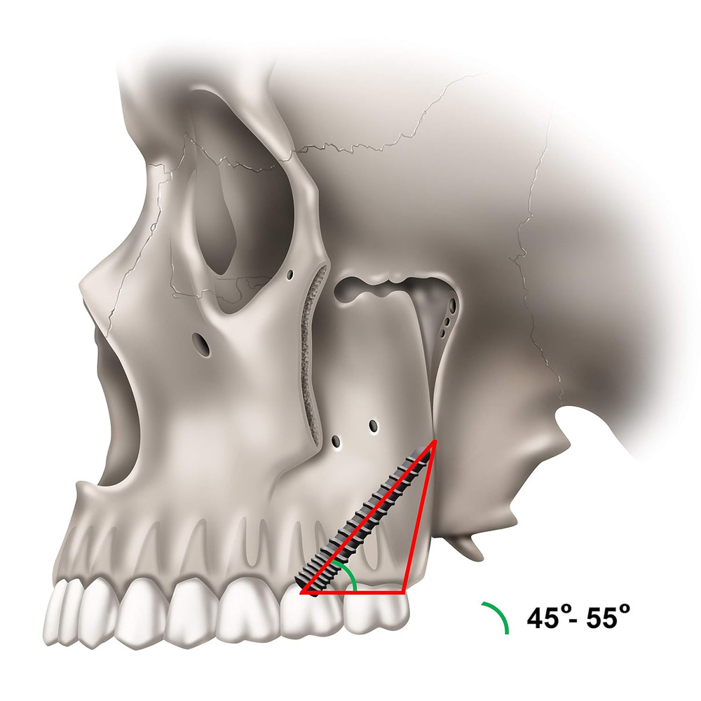 Pterygoid Implants: the Art and Science