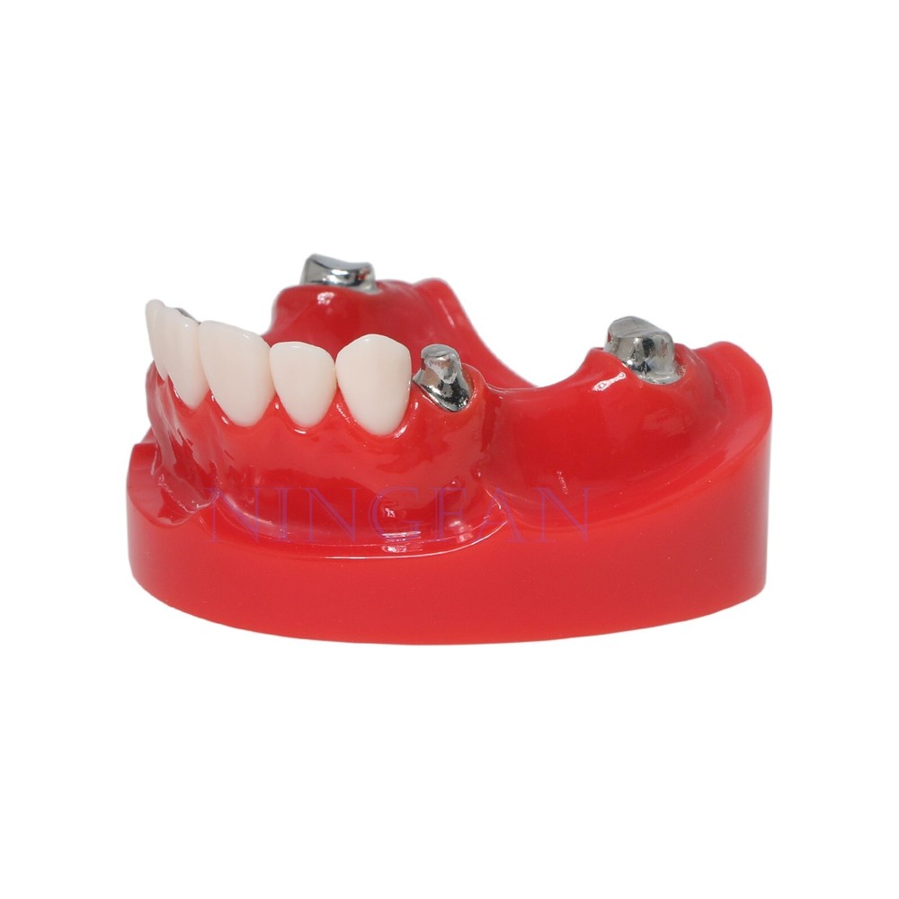 Dental Typodont Removable Partial Denture Model ,PRD Telescopic Crown Denture