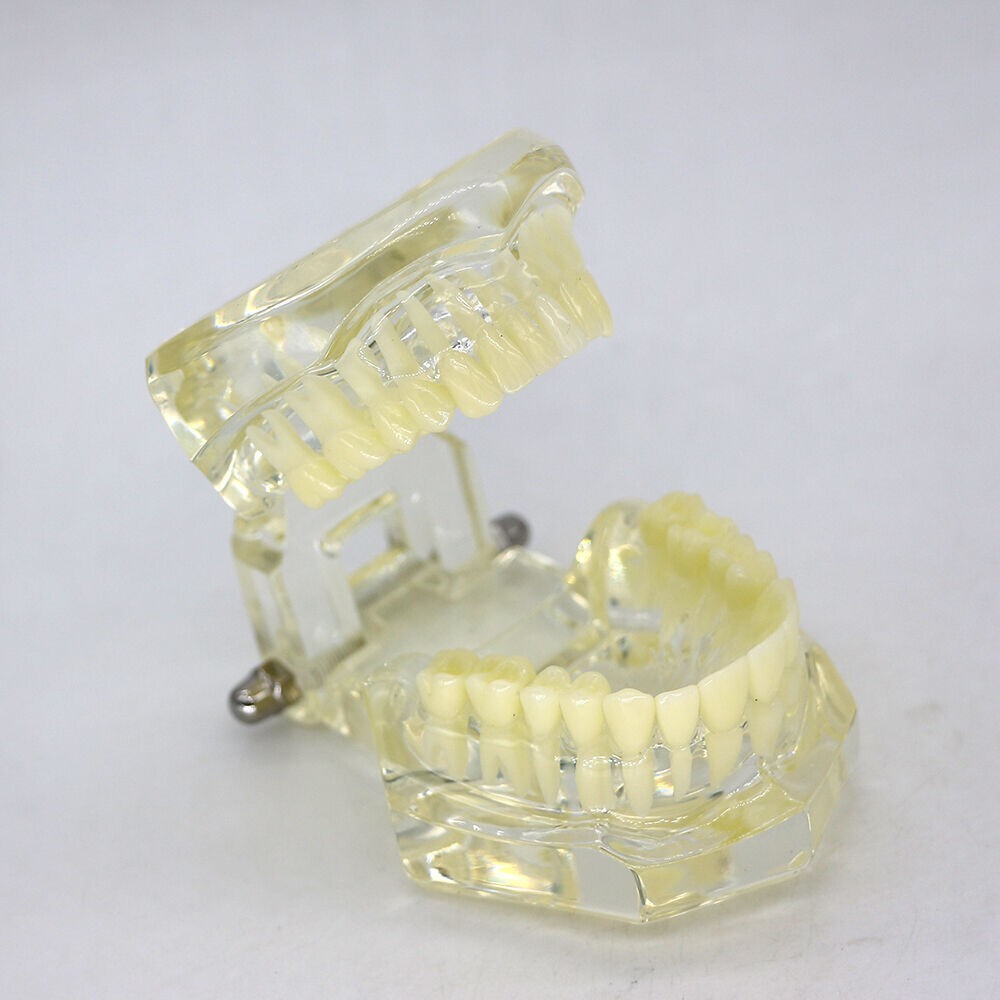 1×Yellow Transparent Plastic Study Teeth Model Demonstrate Comprehensive Repair