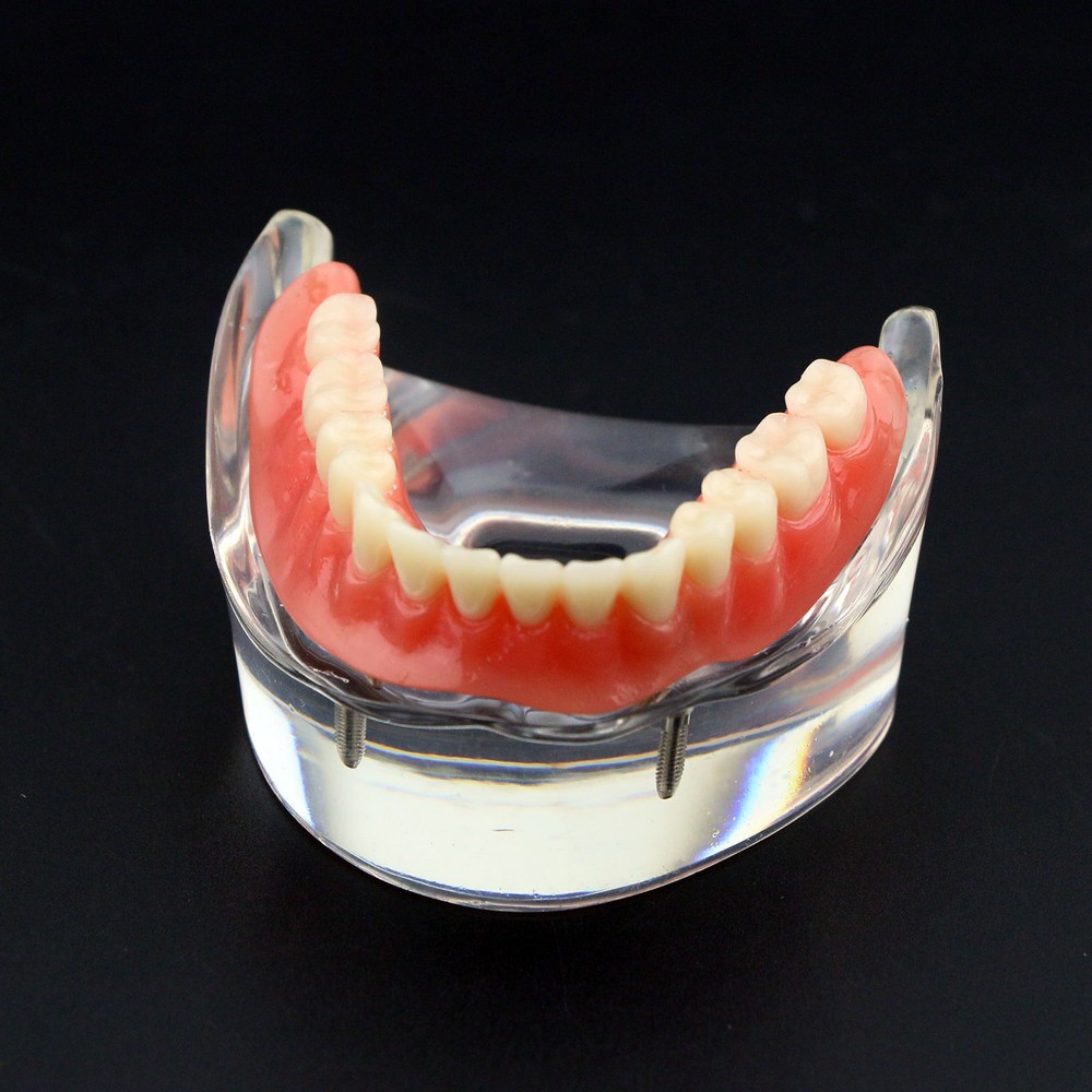 Dental Oral Transparent Upper Teeth 2/4 Implants Model Overdenture Restoration