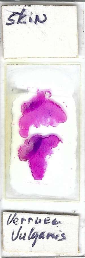 Human Wart Verruca Vulgaris Pathology Microscope Slide