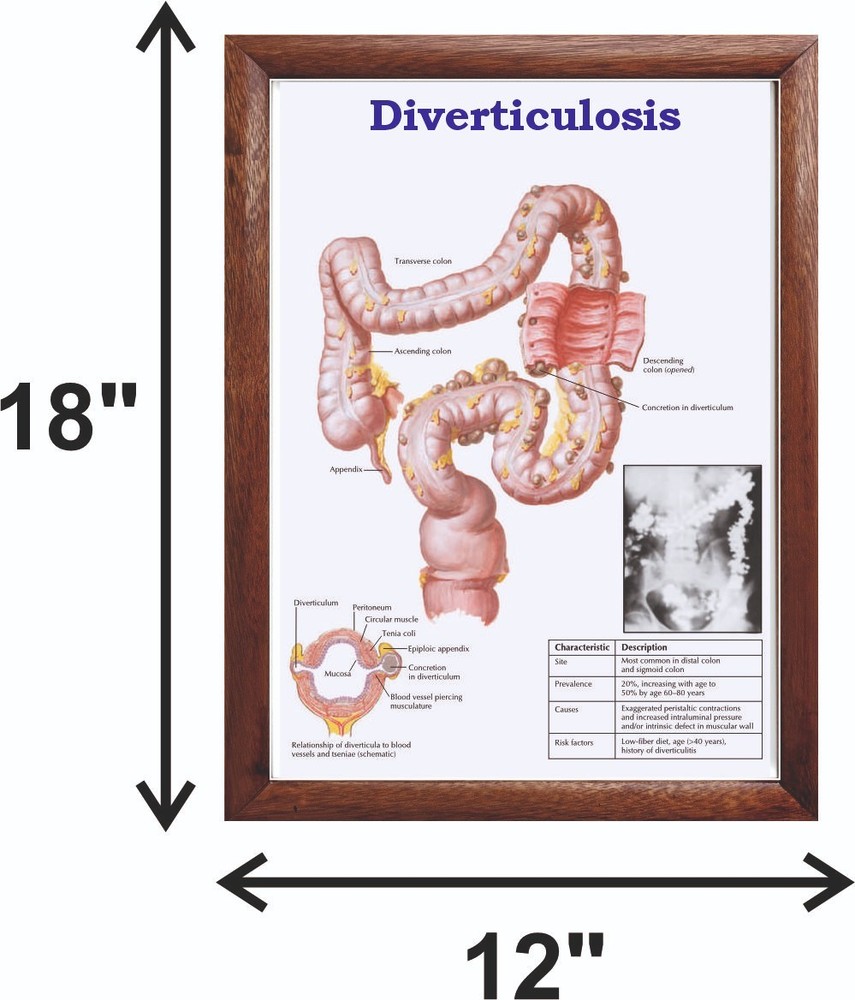 Diverticulosis Chart 12x18 inches