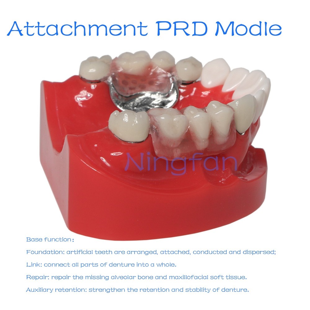 Dental Typodont Removable Partial Denture Model ,PRD Telescopic Crown Denture