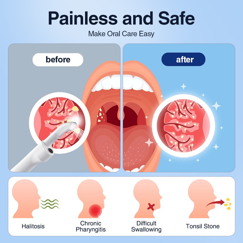 Visible Tonsil Stone Removal Kit with HD Camera Electronic Tonsil Stone Remove