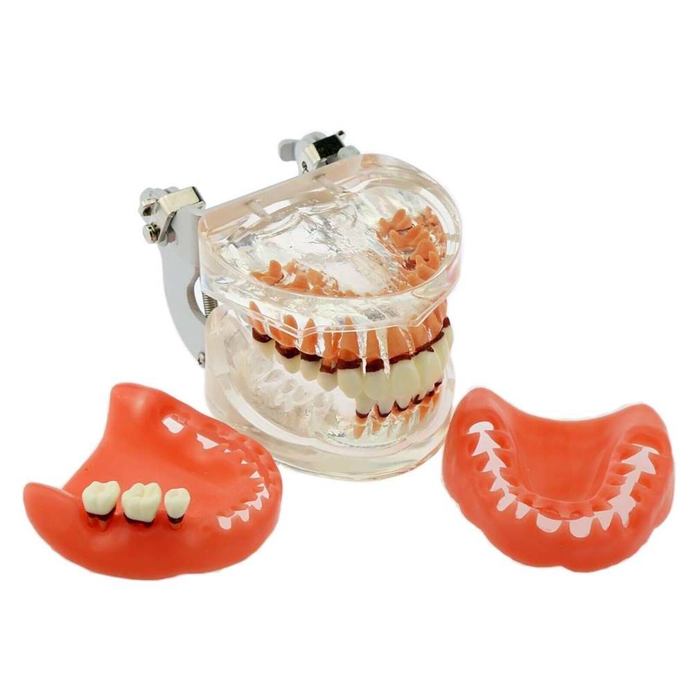 Dental Periodontal Pathological Disease M4017 Removable Teaching Study Model