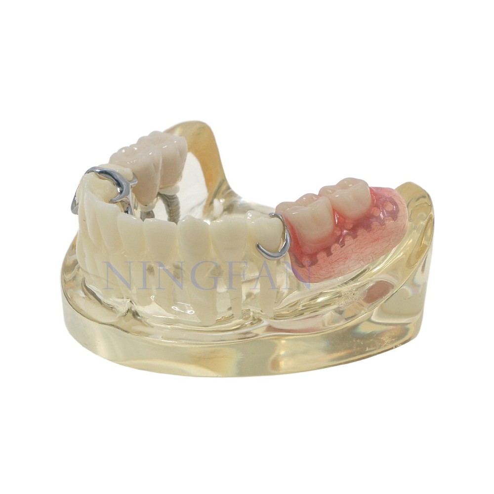 Dental Typodont Restoration Teeth Model With Partial Denture Demo 2 Implants
