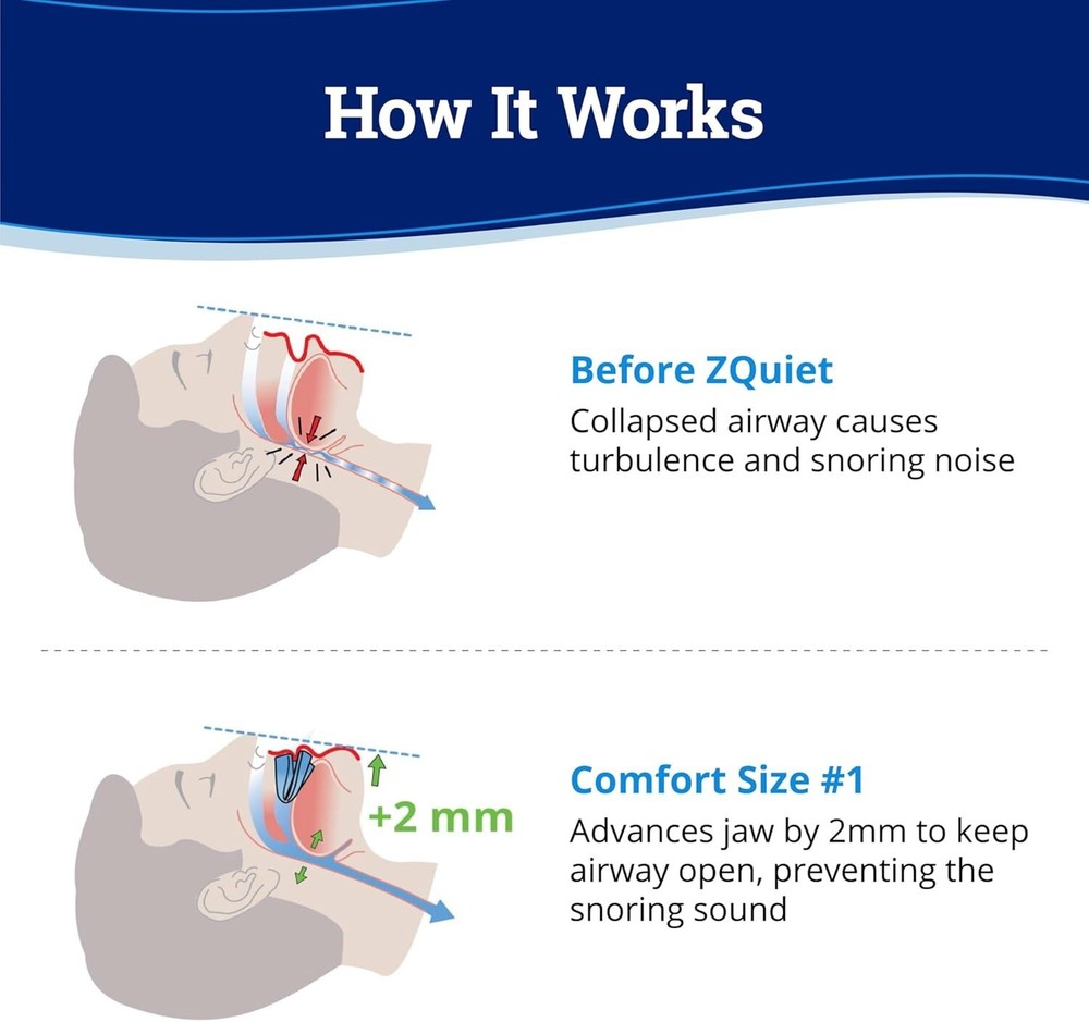 ZQuiet Anti-Snoring Mouthpiece Solution - Comfort Size #1 (Single Device)