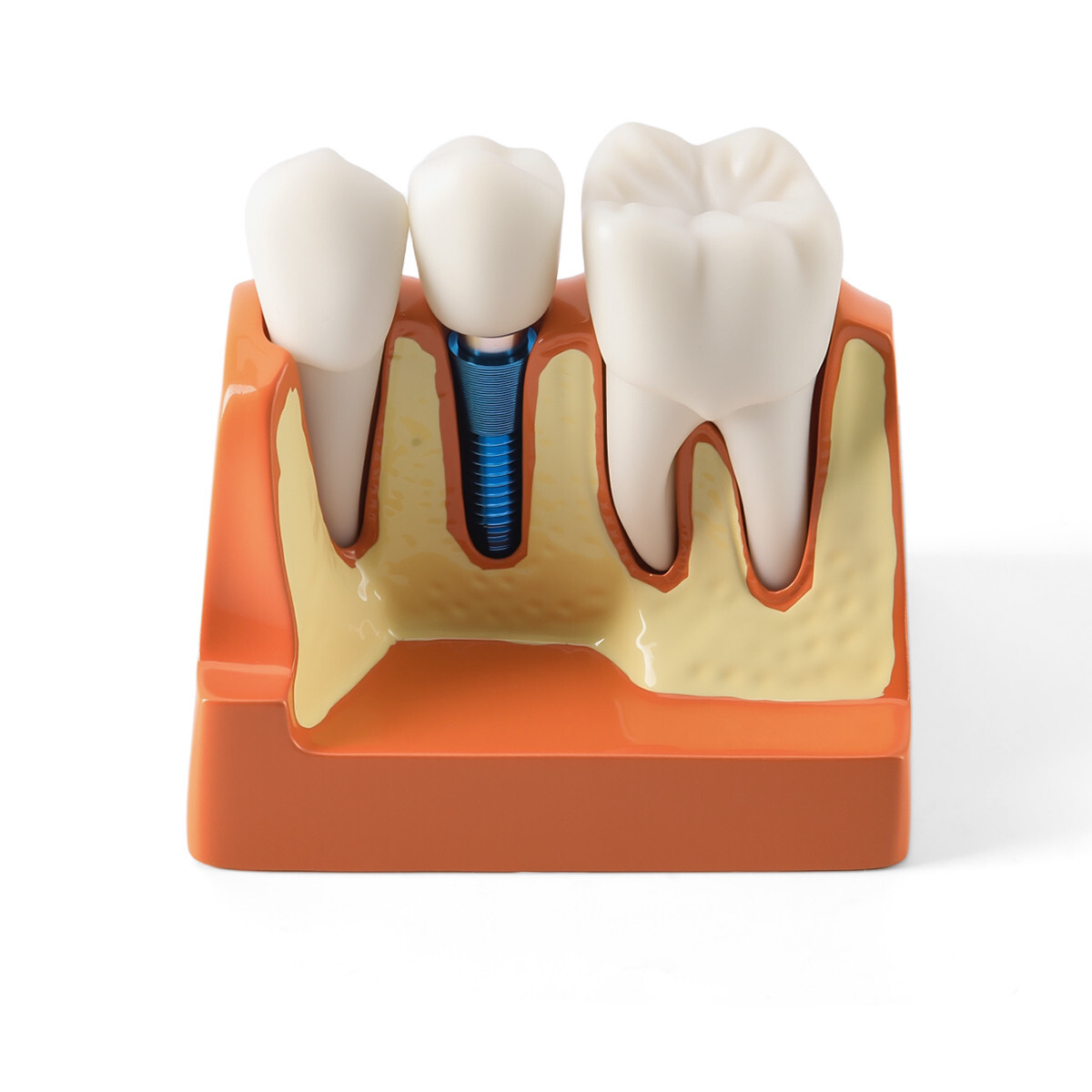 4 Times Dental Teeth Removable Model Implant Teaching Learning Tool Analysis