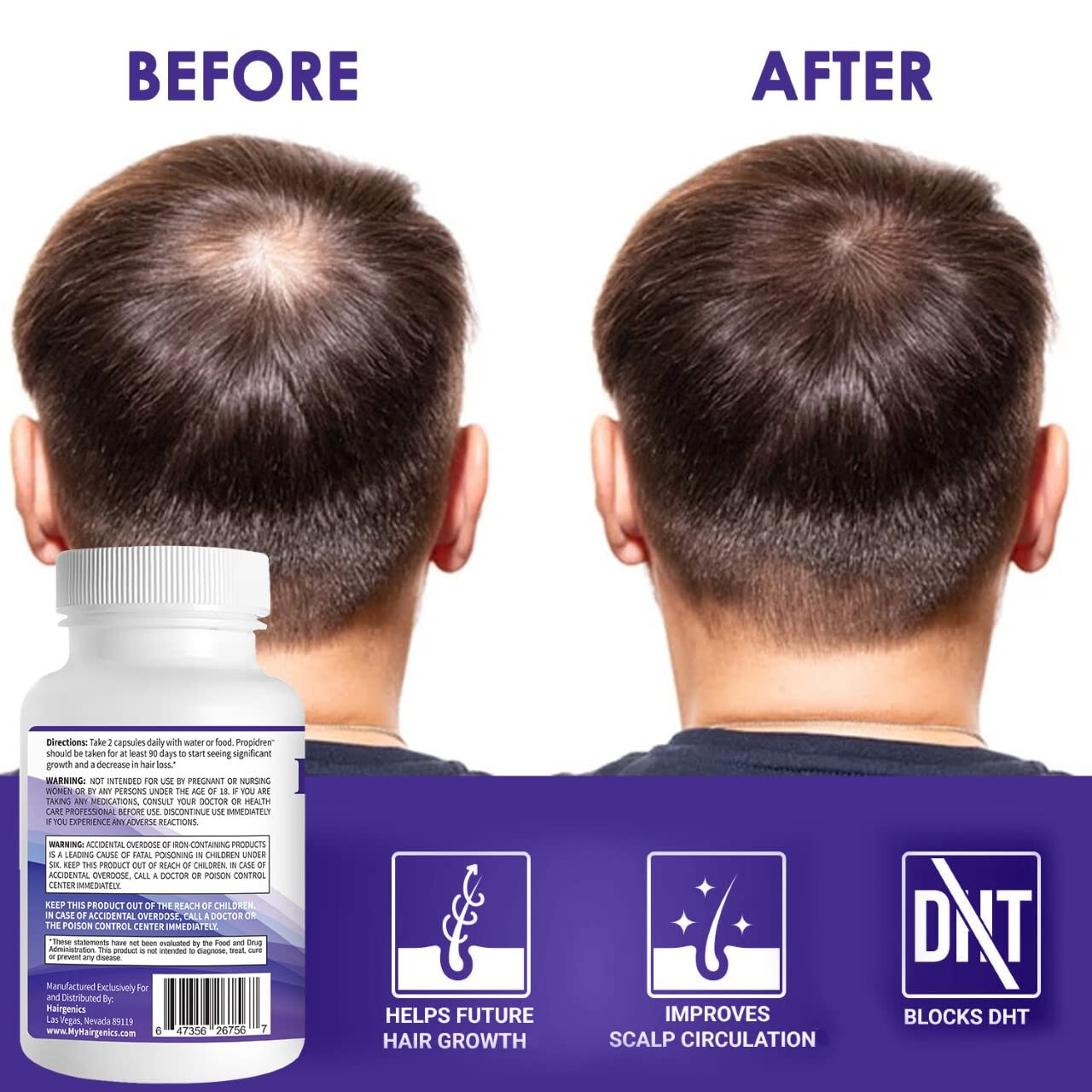 Propidren by HairGenics - DHT Blocker with Saw Palmetto To Prevent Hair Loss
