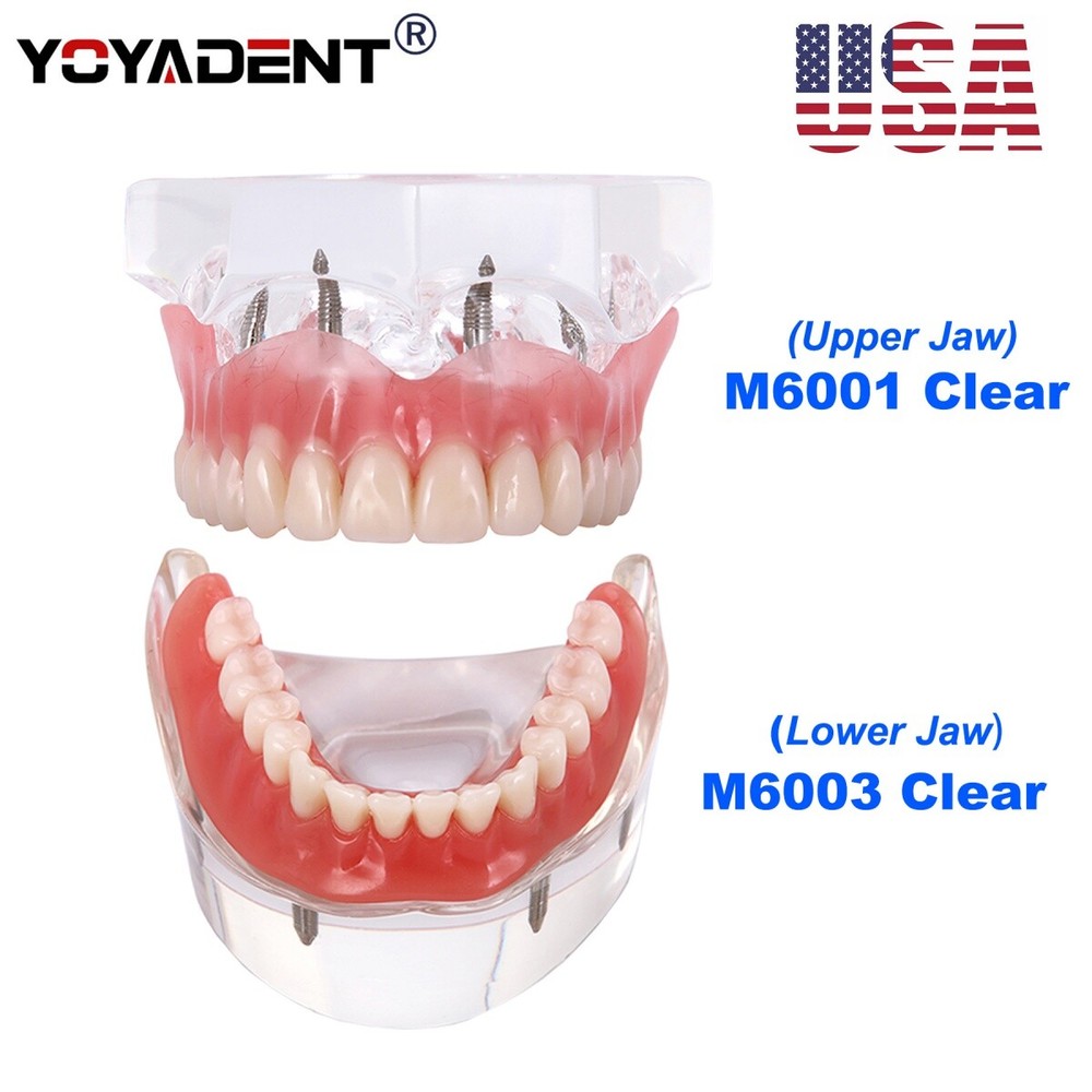 Dental Teeth Model Removable Overdenture Teeth Upper/Lower Jaw 4 Implants Model