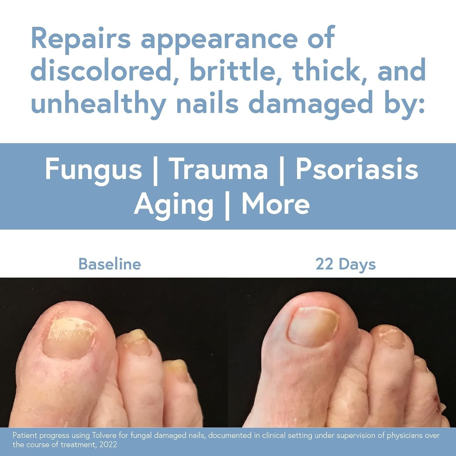 Tolvere Nail Renewal Solution, from the Makers of Tolcylen, Rapidly Improve