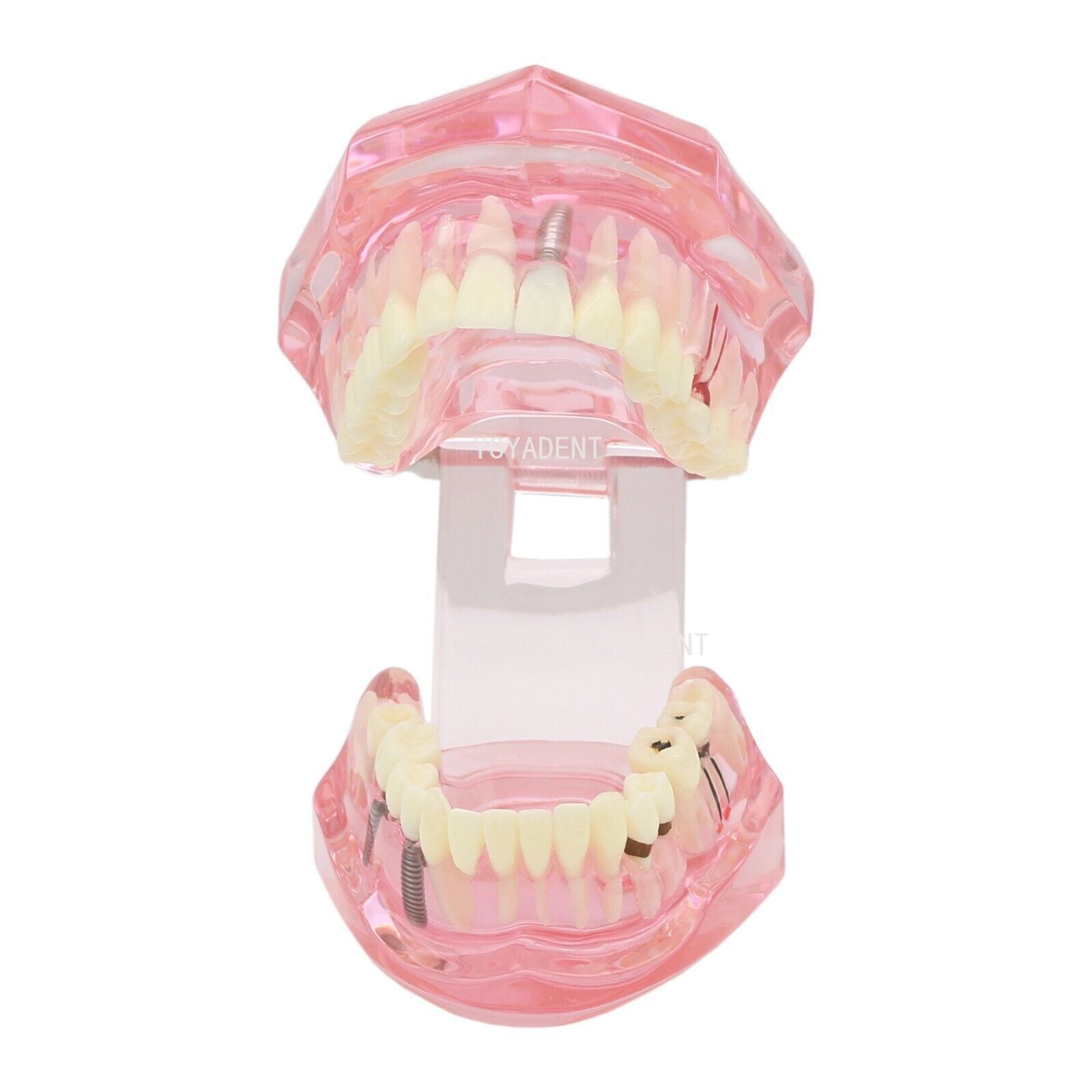 Dental Teeth Model Study Orthodontic Removable Teeth Implant Teaching Model