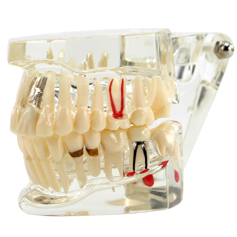 Dental Transparent Pathological Teeth Study Model Implant and Restoration Model
