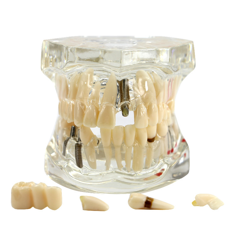 Dental Study Teach Implant Teeth Model Restoration Bridge Caries Denture Educate