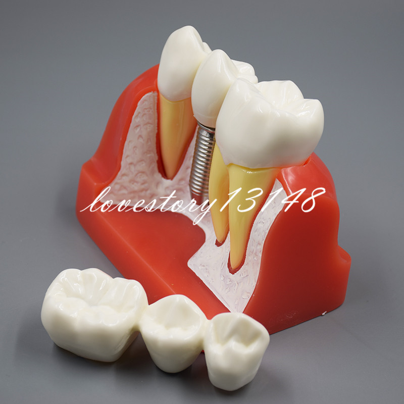 Dental Implant Analysis Crown Bridge Demonstration Teeth Tooth Study Model