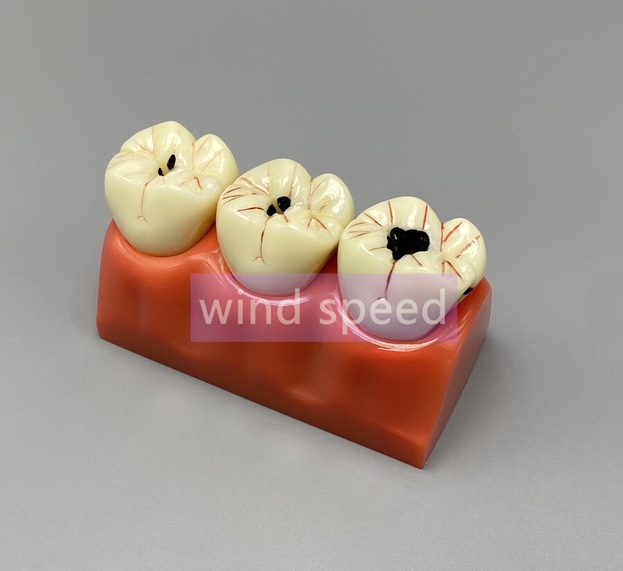 Dental Teaching Model 4 Times Caries Disassembling Comparations Implant Model
