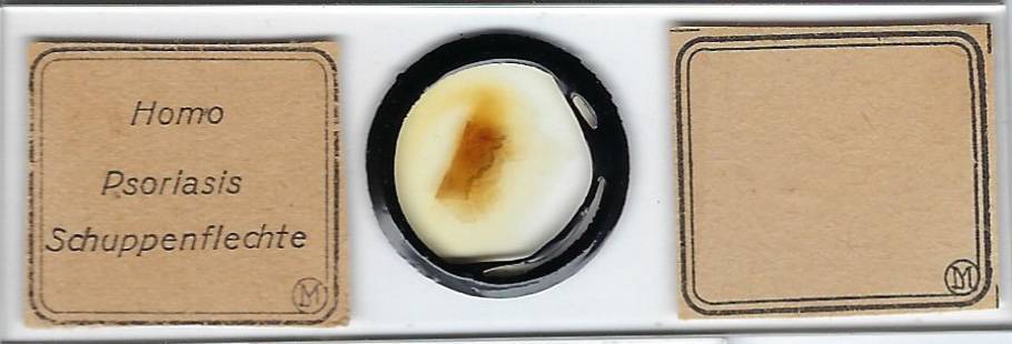 Human Psoriasis Pathology Microscope Slide by Moeller