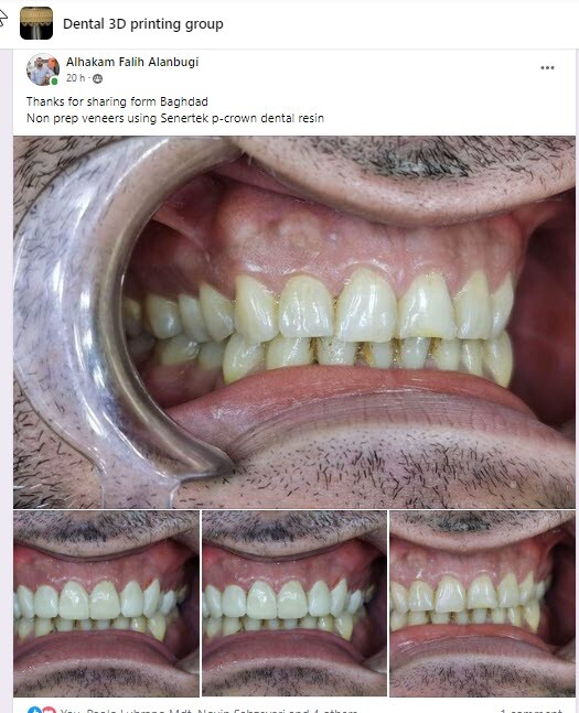 DLP SLA LCD 3d printer permenant crown - teeth resin ..