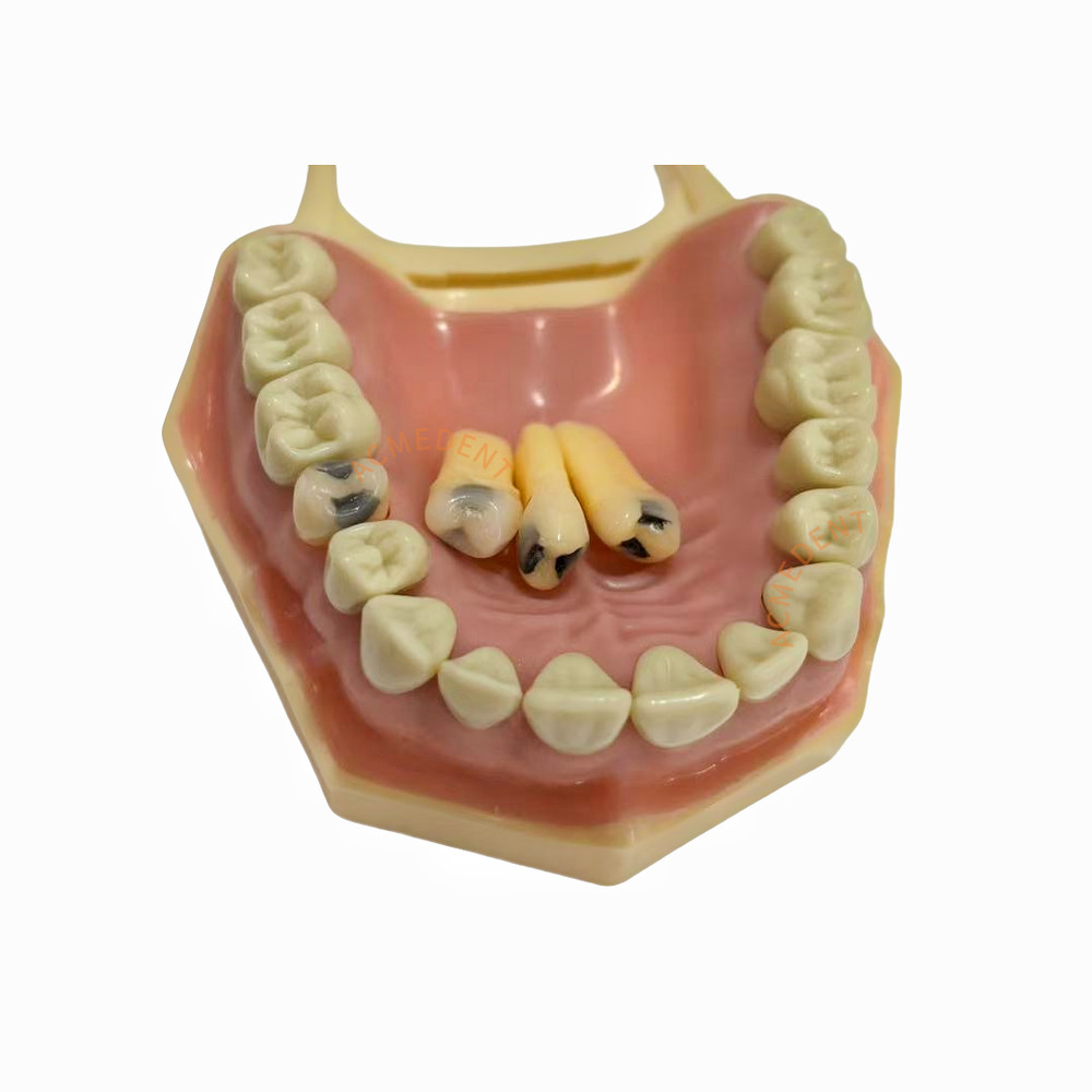 Dental Frasaco AG3 Caires Model Typodont Replacement Decay Removable Teeth AG-3