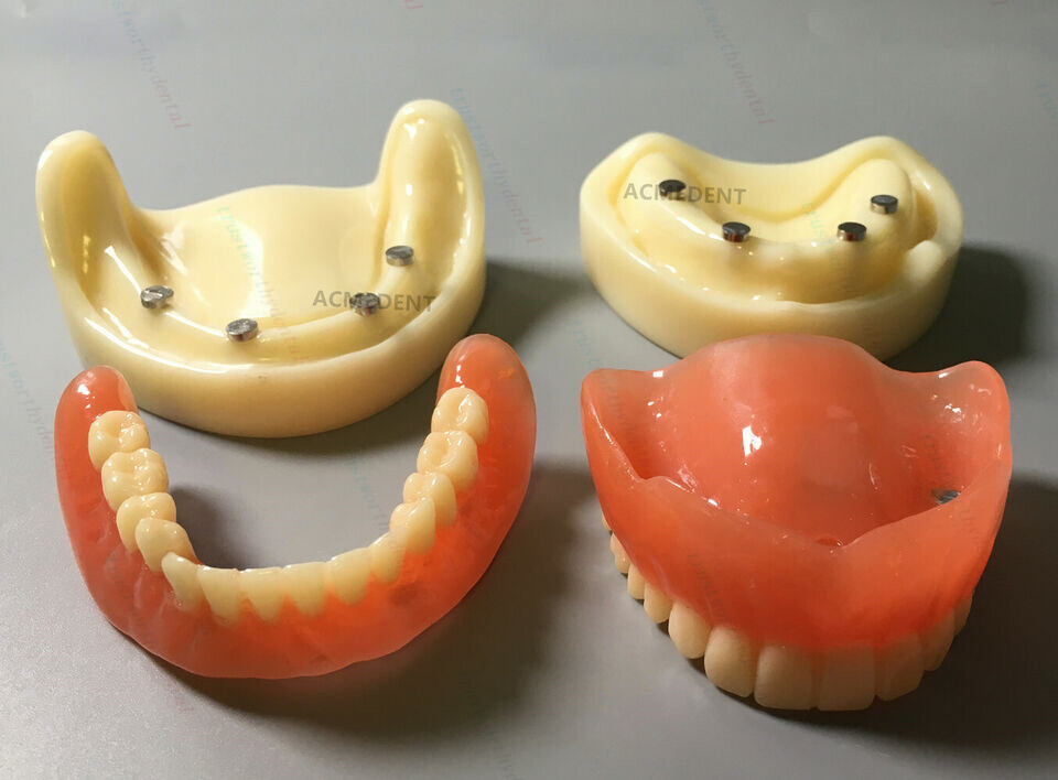 Dental Full Denture Model Overdenture Magnetic Attachment Mandibular Upper Study
