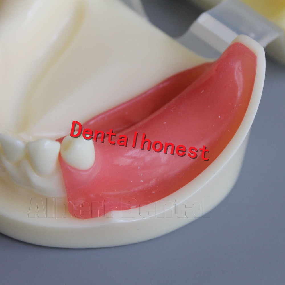 Great Dental Full Implant Drilling Practice Teeth Study Model Typodont Model