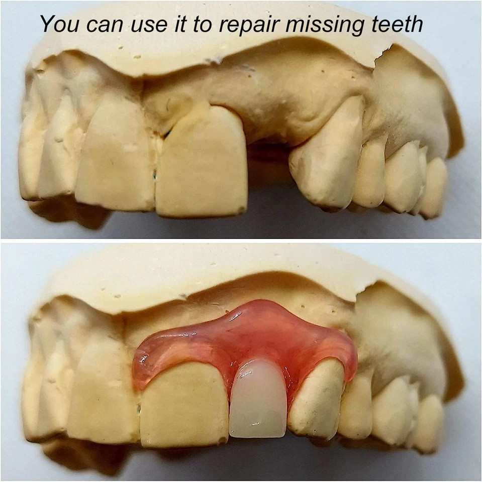 Gum Material Repair Strip for Missing Teeth Partial Full Dentures Quick Fix