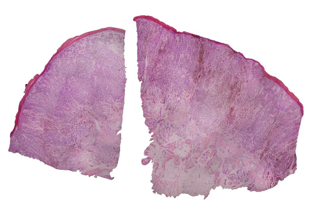 Melanoma (Human); Cross Section; H&E Stain