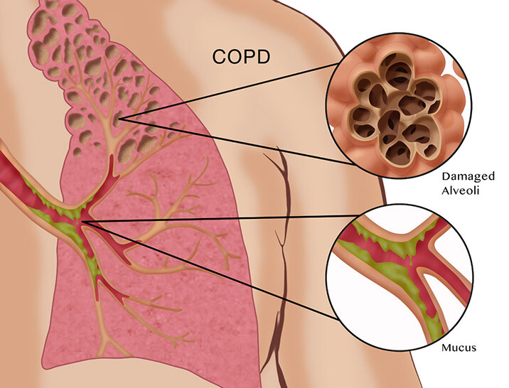 Serious Support for Asthma, Bronchitis, Emphysema, COPD - Opens Lung Airways.
