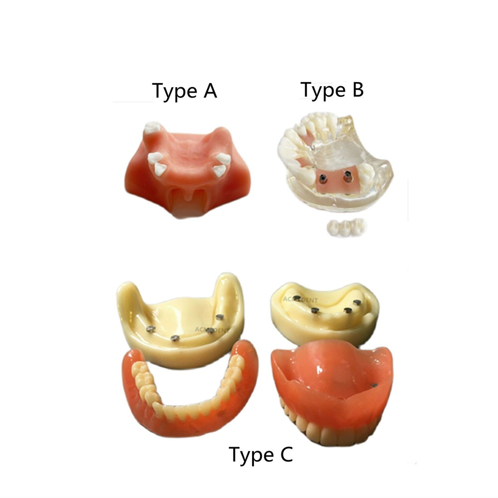 Dental Teeth model with Maryland Bridge Caries Teach Study Model