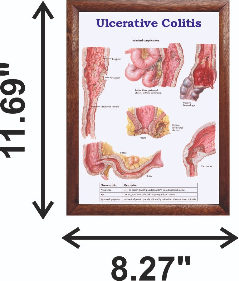 Ulcerative Colitis Chart 12x18 inches