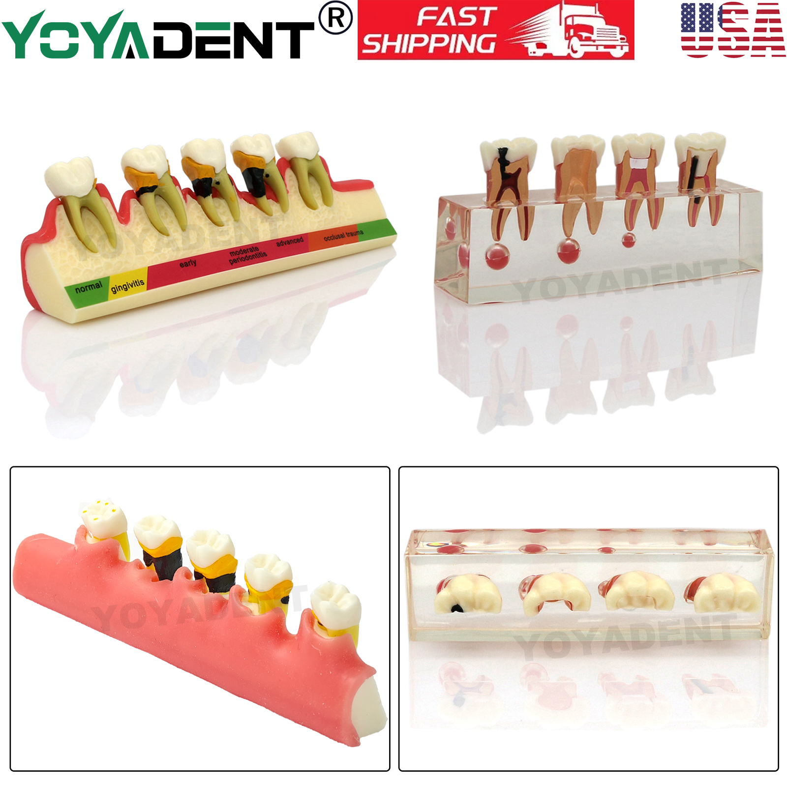 Dental Model Periodontal Disease Assort Teeth Model Endodontic Teaching Demo US