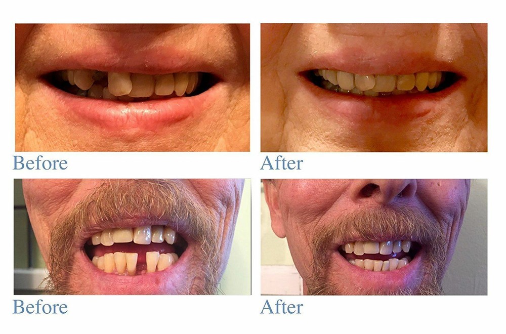 Instant Smile Select a Tooth Temporary Tooth Replacement Kit Comes in 3 shades