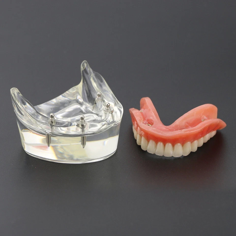 Dental 2/4 Implants Upper Lower Teeth Model Lower Demo Overdenture Restoration