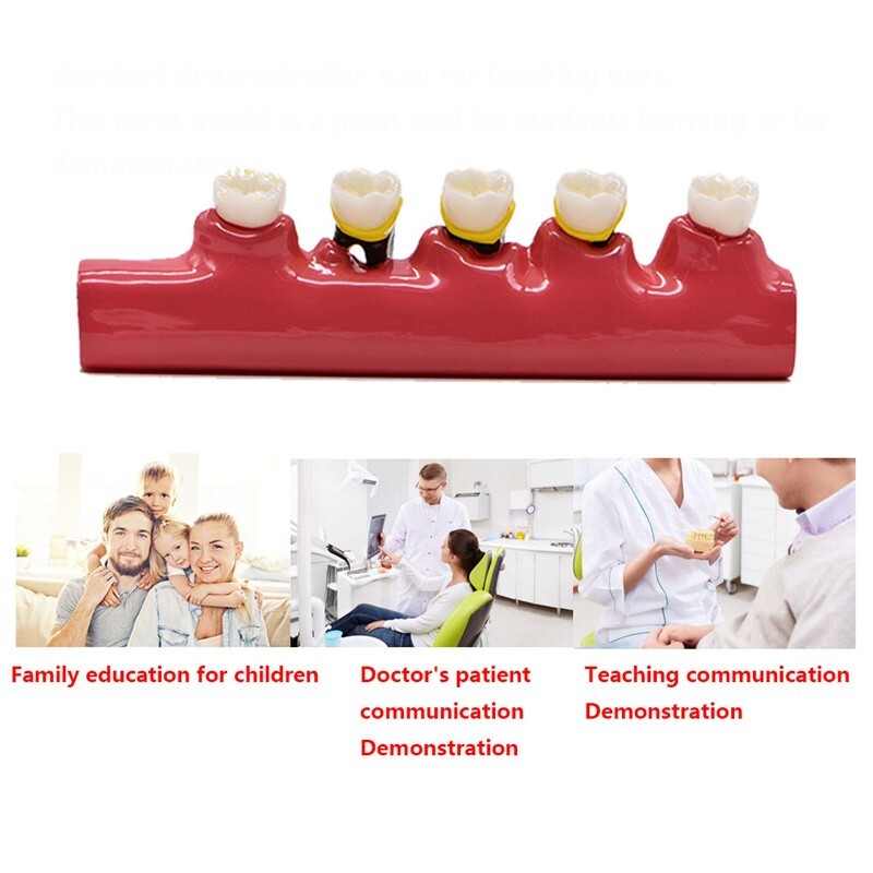 Dental Study Teaching Model Periodontal Disease Assort Teeth Dentoform Typodont