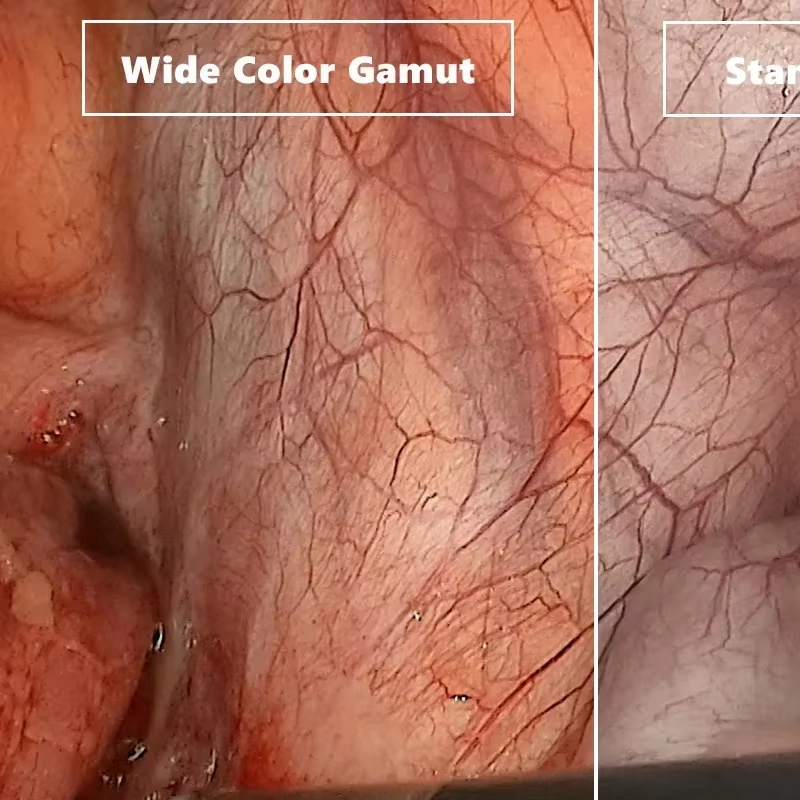video laryngoscope/ gastrointestin/bronchus endoscopy Include screen