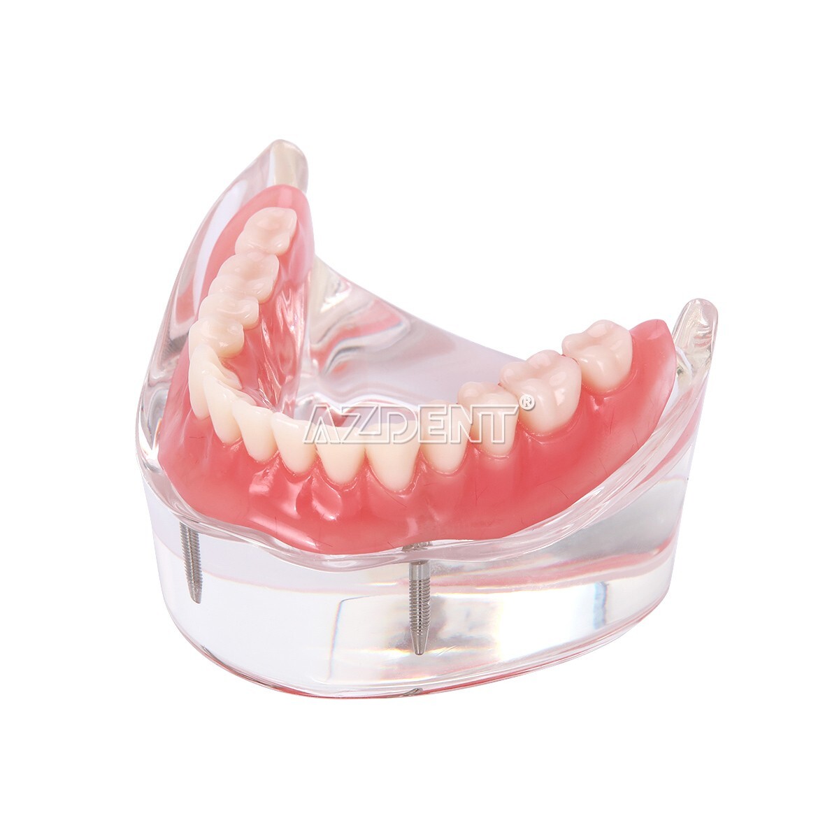 Dental Implant Teeth Model Demo Overdenture Restoration With Implants Lower