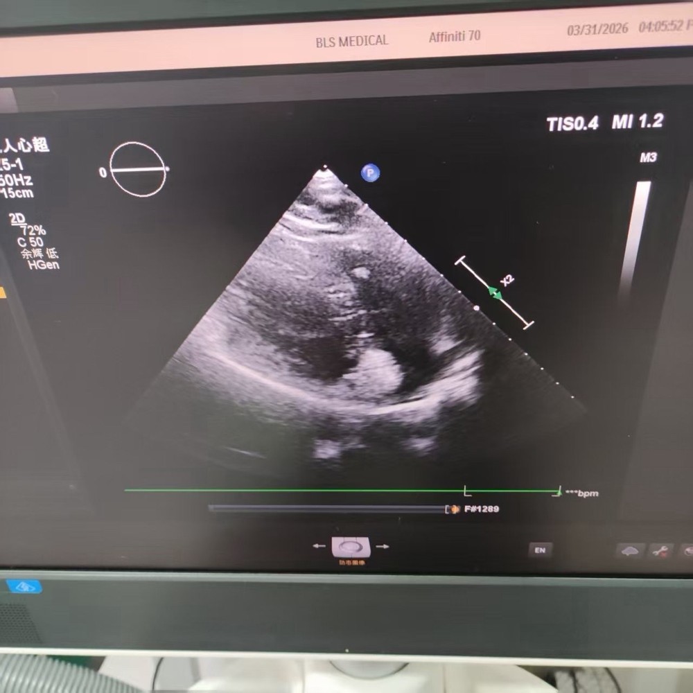 Philips X5-1 Epiq