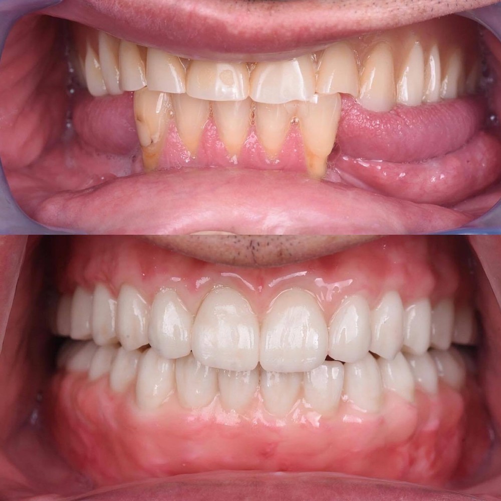 DLP SLA LCD 3d printer temporary teeth resin ..