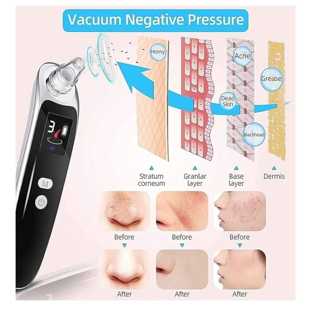 Advanced Blackhead Remover Vacuum - Black