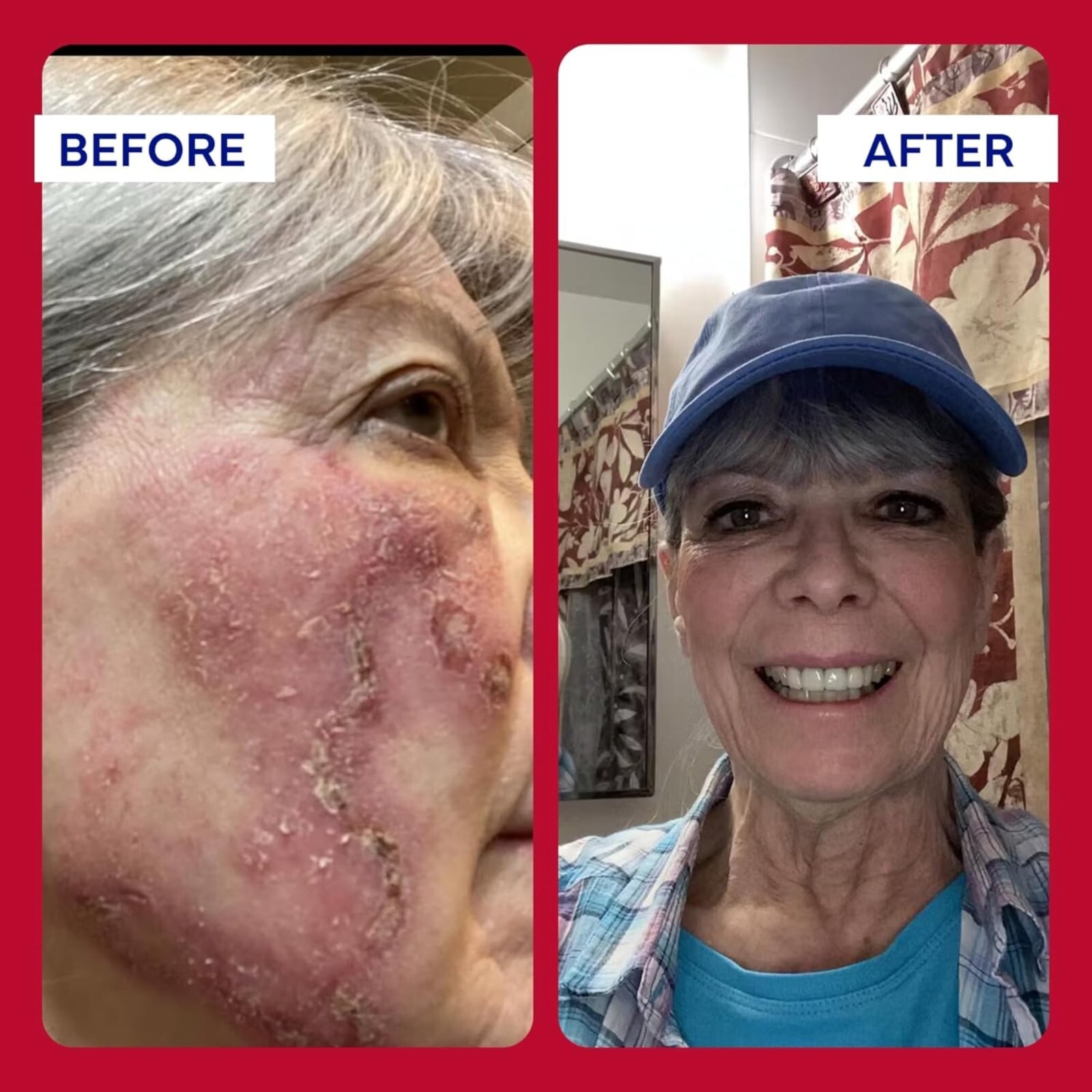 EMUAID Max First Aid Ointment For Reduces Pain, Infection, Inflammation 2oz.