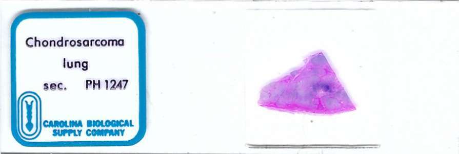 Human Chondrosarcoma of Lung Pathology Microscope Slide