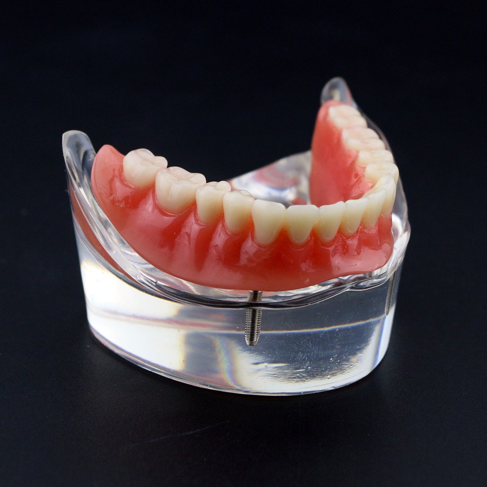 Dental Oral Transparent Upper Teeth 2/4 Implants Model Overdenture Restoration