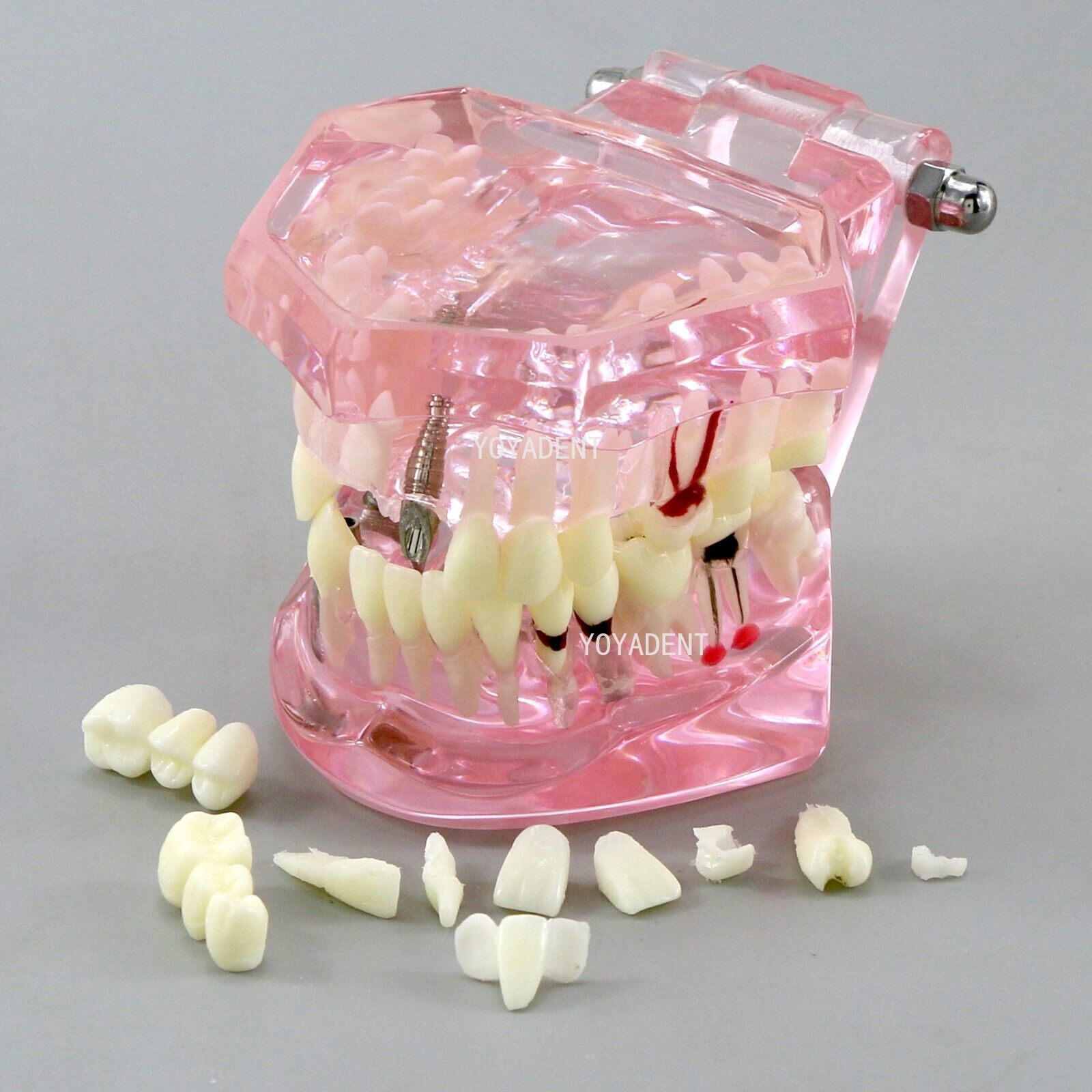 Dental Teeth Model Study Orthodontic Removable Teeth Implant Teaching Model