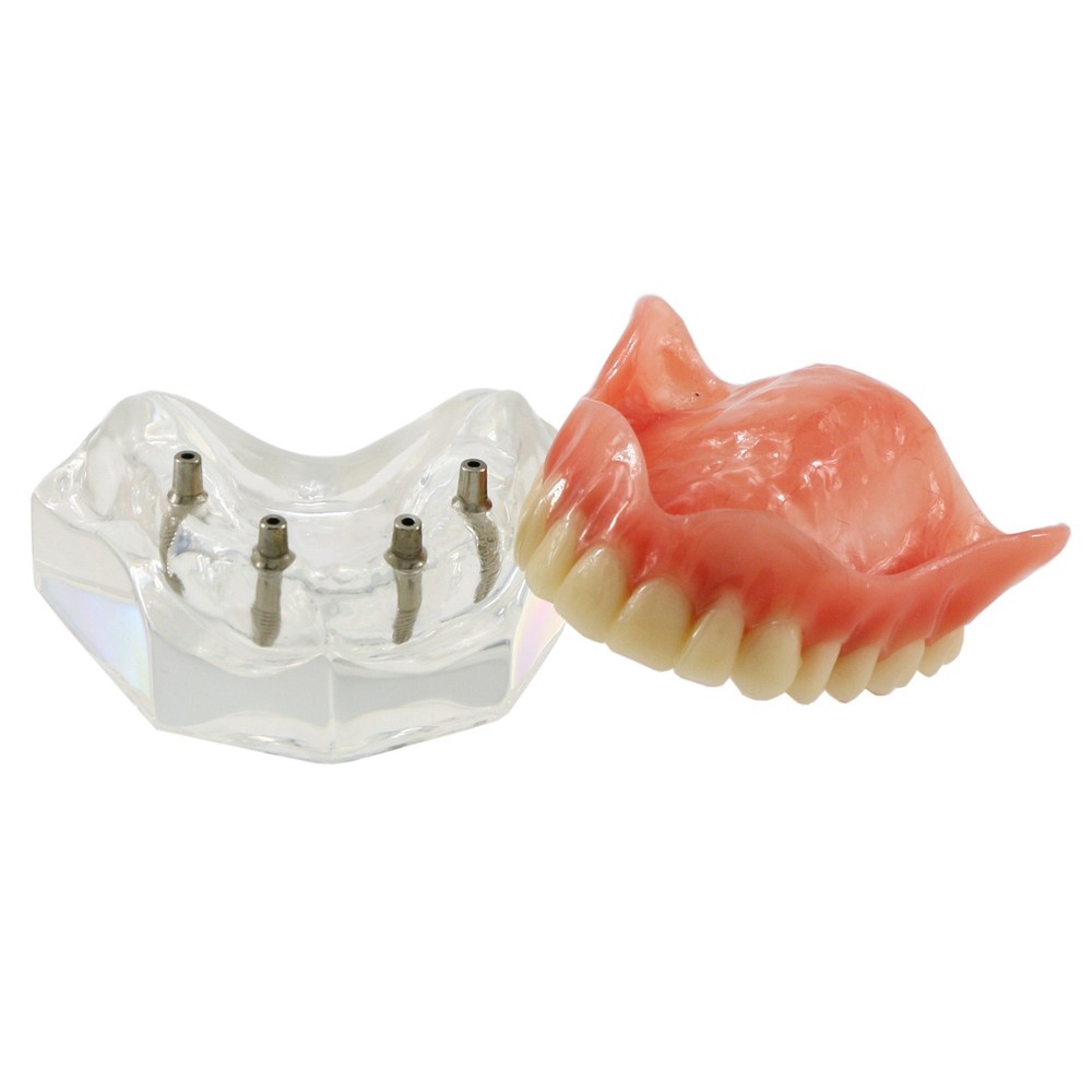 Dental Teeth Model Overdenture Removable Teeth Upper/Lower Jaw 4 Implants Model