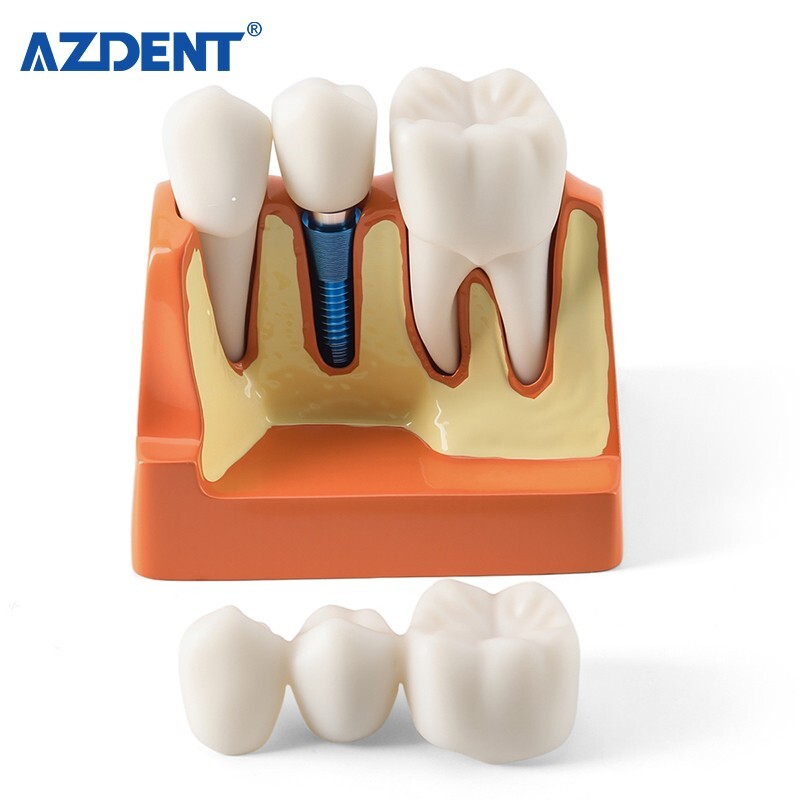 4 Times Dental Teeth Removable Model Implant Teaching Learning Tool Analysis