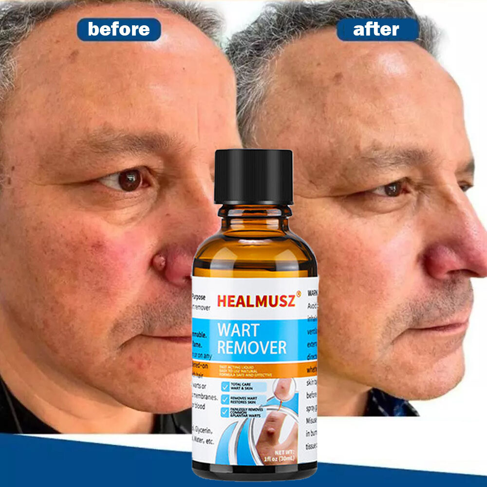 Wart Remover Liquid Skin Tag Mole Remover Eliminate Feet Corn Wart Remove Liquid