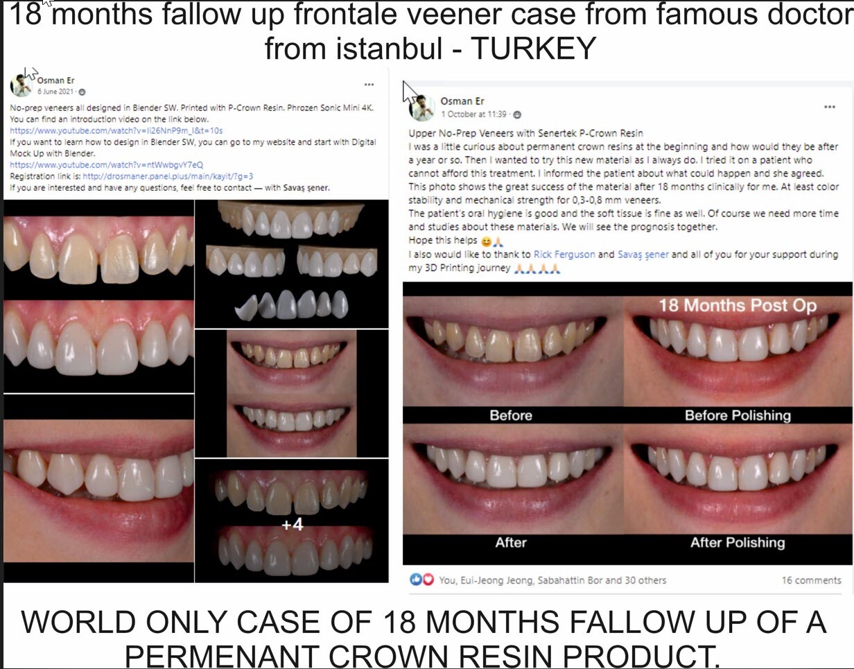 DLP SLA LCD 3d printer permenant crown - teeth resin ..